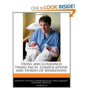  Twins and Conjoined Twins Facts, Complications and 